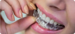 Clear Aligners