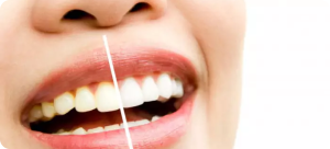 Teeth Whitening