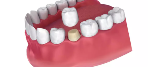 Dental Crowns