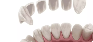 Dental Veneers