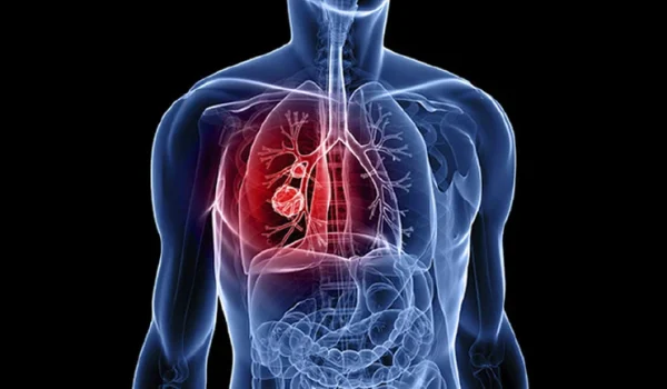 Lung Cancer