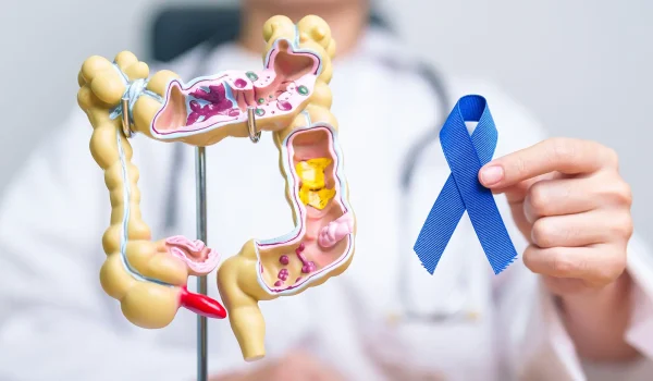 Colon Cancer